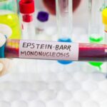 Epstein-Barr Virus Management: Key Insights & Tips