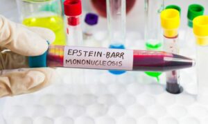 Epstein-Barr Virus Management